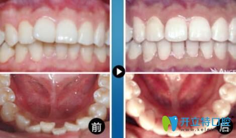 重慶華美口腔王偉好不好？真人牙齒矯正案例效果公布