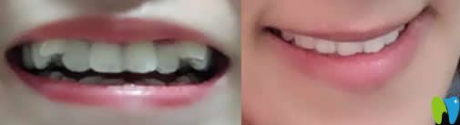 京通口腔隱形牙齒矯正前后對比圖