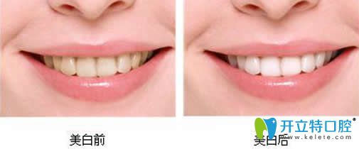 北京京通口腔冷光美白