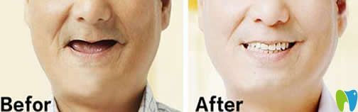 北京京通口腔全口種植牙