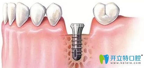 牙周炎對種植牙有哪些影響