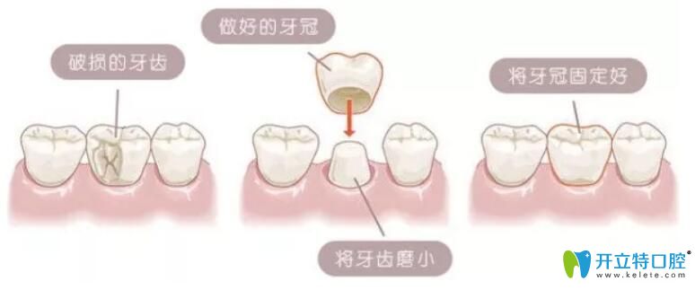 烤瓷牙真的那么可怕嗎