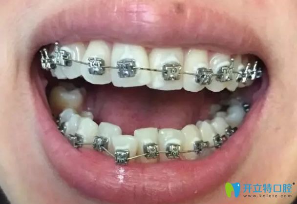 牙齒矯正天