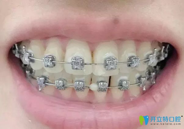 牙齒矯正第500天