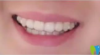 時代天使隱形矯正1年效果