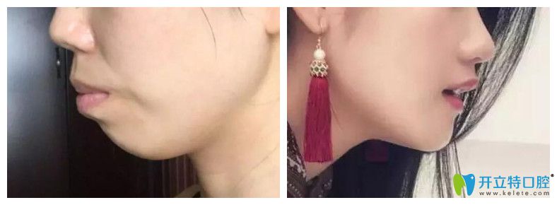 突嘴齙牙矯正前后對比照 突嘴齙牙矯正前后對比照