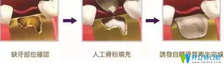 骨粉是個什么東西？為什么種牙要植骨粉