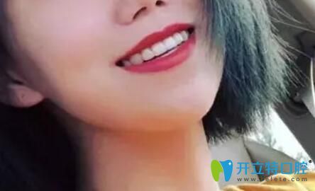 愛麗諾口腔牙齒矯正一年半下牙套效果圖 愛麗諾口腔牙齒矯正一年半下牙套效果圖