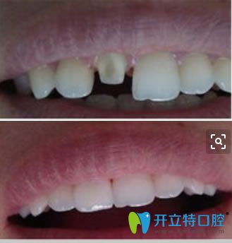 二氧化鋯全瓷牙修復(fù)前后對(duì)比效果