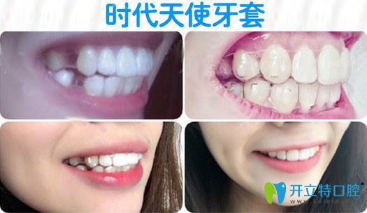 金華芘麗芙成年人時(shí)代天使隱形矯正對(duì)比效果