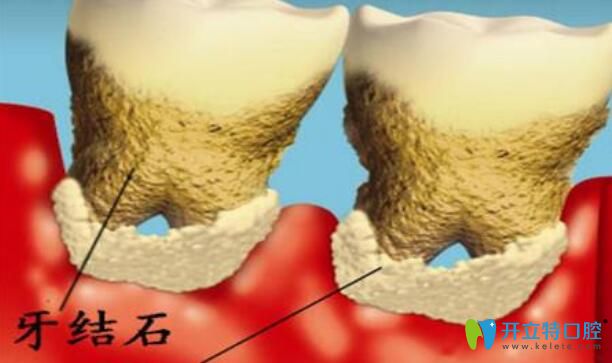 牙齒破碎脫落什么原因以及牙齒破碎后的修復(fù)方法公布
