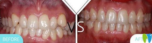 凱樂(lè)口腔牙齒矯正前后對(duì)比圖