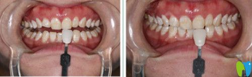 瓷貼面前牙齒情況