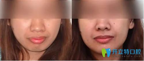 廣州壹加壹蘇文新院長(zhǎng)成人自鎖托槽矯正對(duì)比效果