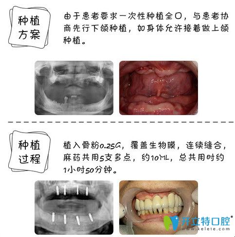 東莞好百年口腔怎么樣？60歲老人全口牙種植案例見證