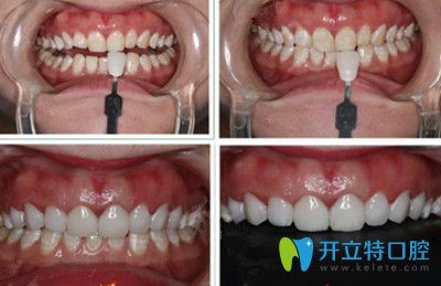 全瓷貼面牙齒前后對(duì)比圖