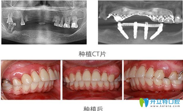 維樂口腔即刻種植前后對(duì)比圖