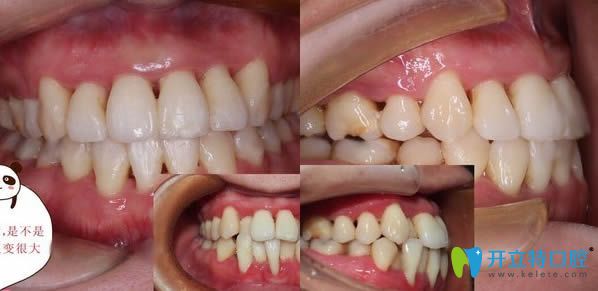 廈門(mén)登特口腔隱形牙齒矯正前后效果對(duì)比圖