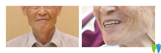 張尚堅為60歲老伯做全口牙種植案例