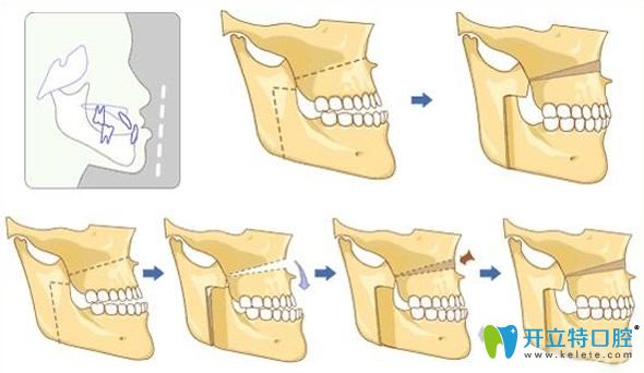 地包天牙齒矯正移動過程圖