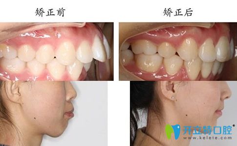 泰州北極星口腔牙齒矯正案例效果