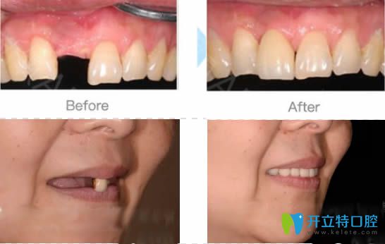 武漢清華陽光陳清華院長(zhǎng)單顆及全口種植牙案例