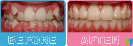 武漢清華陽(yáng)光口腔牙齒擁擠+虎牙矯正后對(duì)比照