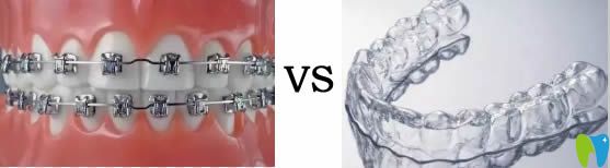 金屬牙套和隱形牙套哪個好