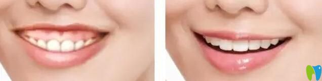 露齦笑矯正前后對(duì)比照片