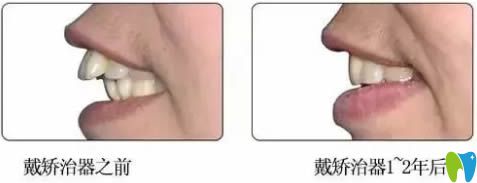 成人齙牙選擇隱形牙套矯正后的對比效果