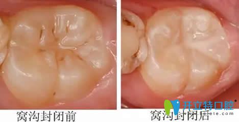 窩溝封閉前后對比圖