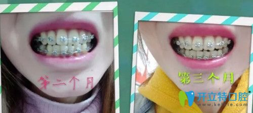 第60天~第90天牙齒已經逐漸排齊