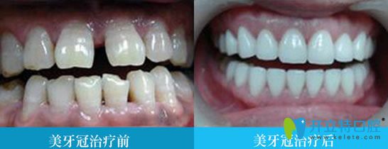 牙齒美容冠修復前后對比圖