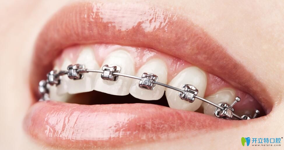 老姐問我唇側(cè)和舌側(cè)矯正哪個(gè)好&價(jià)格是多少
