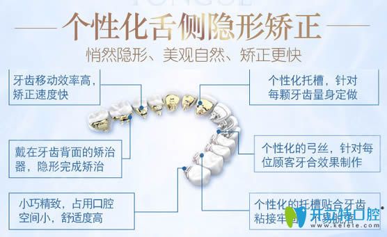 舌側(cè)矯正具有矯正速度快等優(yōu)勢(shì)
