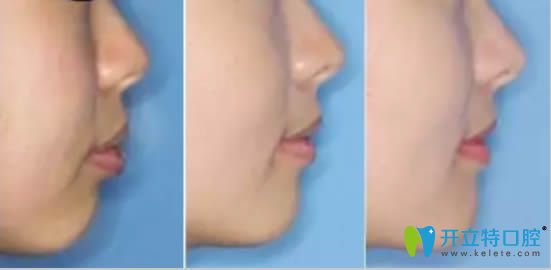 舌側(cè)矯正齙牙案例及臉型變化圖
