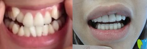 北京壹加壹口腔李真主任隱形牙齒矯正案例