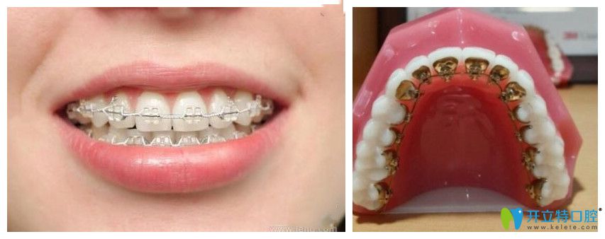 唇側(cè)矯正和舌側(cè)矯正哪個(gè)好呢