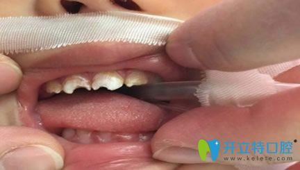 孩子補(bǔ)牙全麻會(huì)影響智力嗎