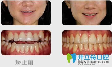南京博韻口腔沈春梅青少年牙齒開合矯正前后對比照