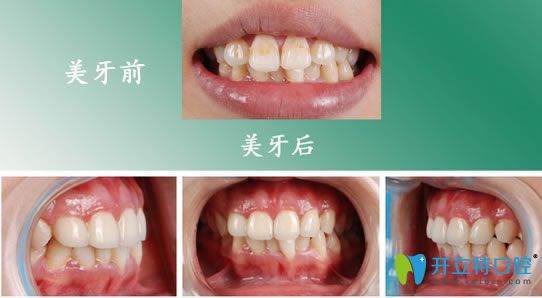 西安中諾孫麗美容冠矯正案例