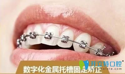 金屬牙套圖片