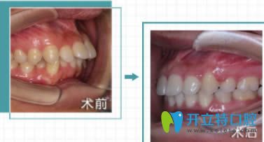 福州維樂口腔許長記醫(yī)生成人齙牙矯正前后對比照