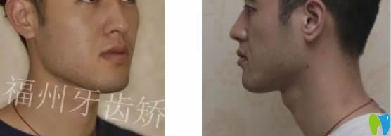 福州維樂口腔郭淑蘋醫(yī)生成人上下前牙反頜矯正臉型對比效果