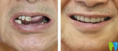 中山好民生口腔黎洪強(qiáng)醫(yī)生多顆牙種植效果 中山好民生口腔黎洪強(qiáng)醫(yī)生多顆牙種植效果