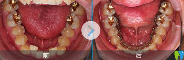 舌側(cè)隱形矯正前后效果圖