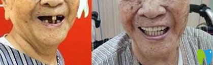 南昌安植雅口腔路文碩醫(yī)生全口種植牙效果 南昌安植雅口腔路文碩醫(yī)生全口種植牙效果