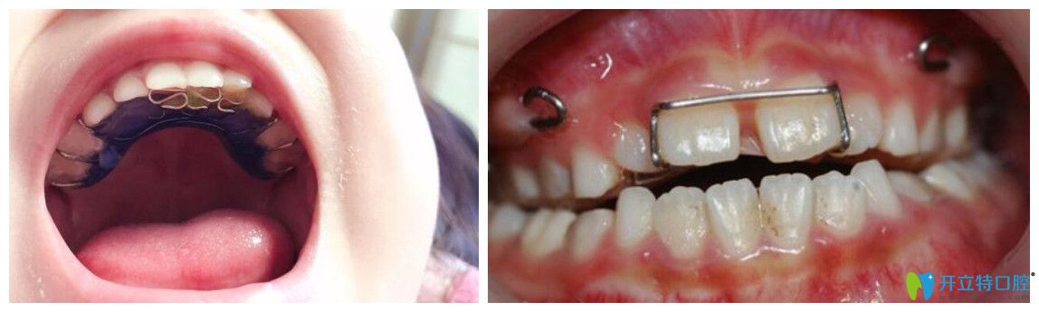反頜矯治器佩戴圖片