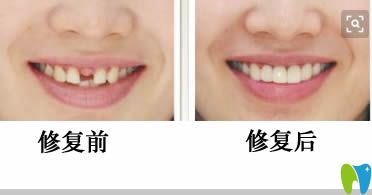 朱錦鋒醫(yī)生前門(mén)牙修復(fù)前后對(duì)比圖
