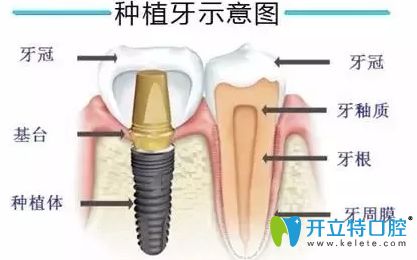 種植牙的價格為什么這么貴？醫(yī)生解開的秘密竟然是......